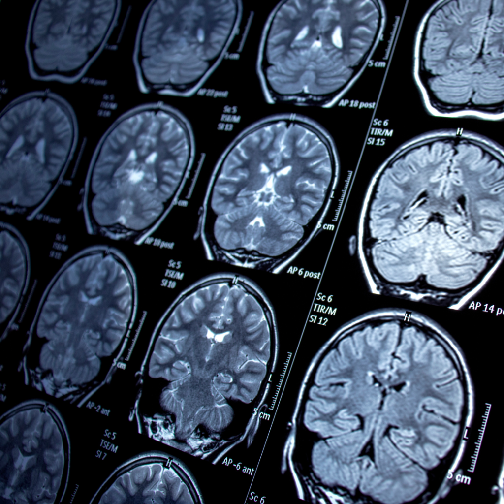 AVS Neurology Scan